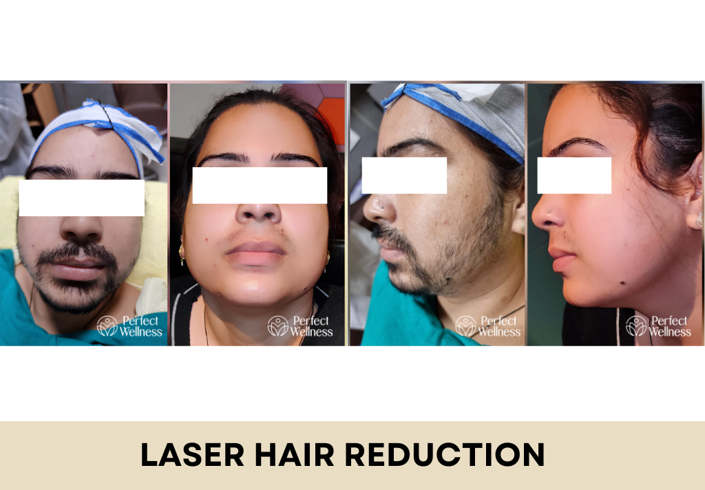 Laser Hair Reduction