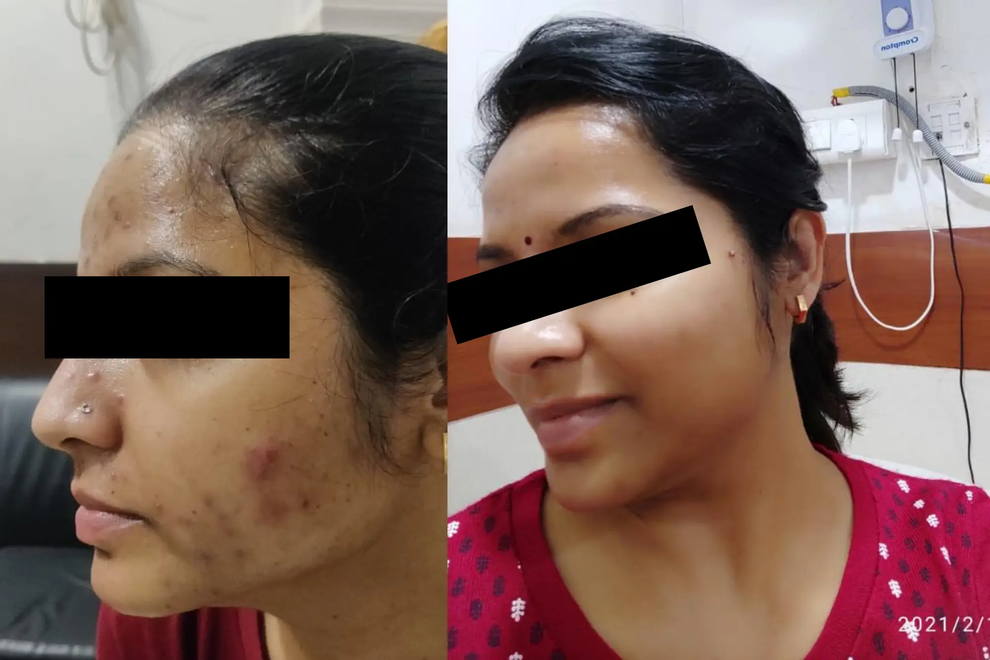 Acne Pits