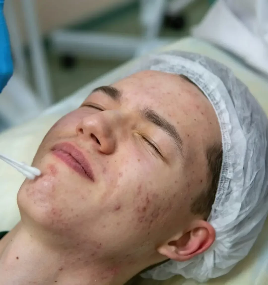 acne-treatment-in-a-teenager--1536x1024